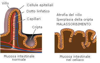 Malassorbimento intestinale celiachia