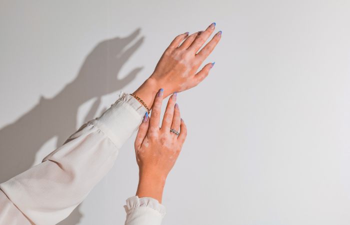 Dermatite alimentazione consigliata