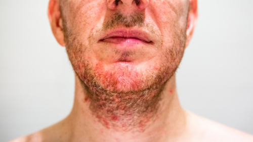 dermatite seborroica cibi da evitare