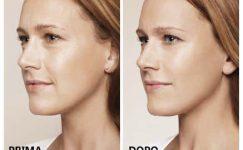 Acido ialuronico viso