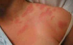 Macchie rosse sulla pelle