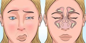 Congestione nasale