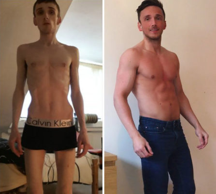 come guarire dall'anoressia