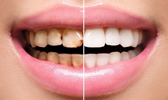 Faccette dentali cosa sono e quanto costano