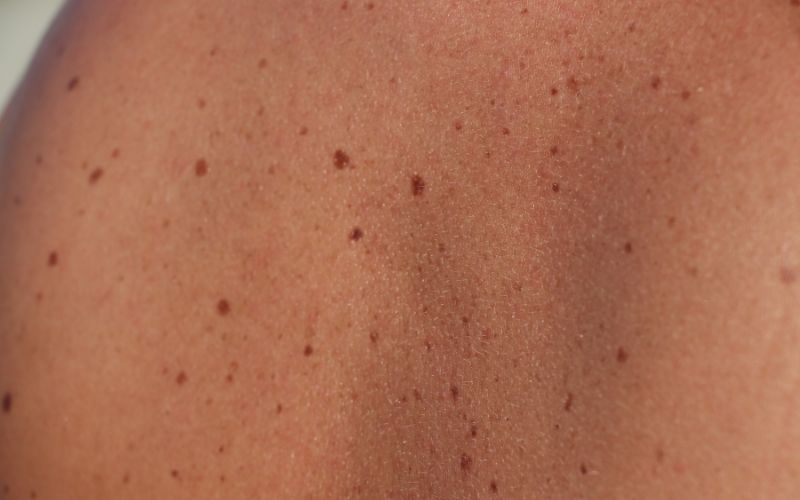 Macchie sulla pelle cause e rimedi gialle Curarsi Naturale Blog