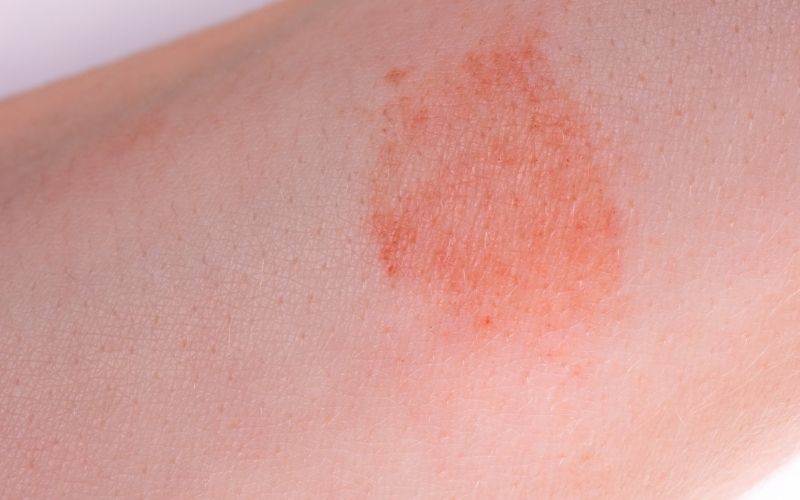 Macchie sulla pelle cause e rimedi gialle Curarsi Naturale Blog