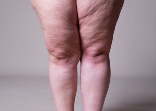 gambe gonfie cure naturali
