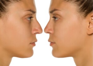 come Raddrizzare il Naso Storto
