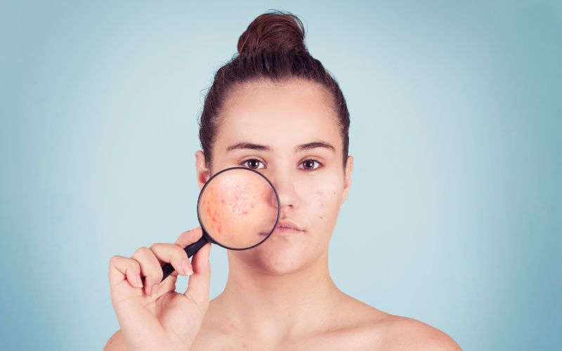 cbd e acne