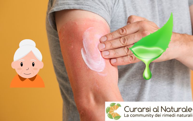 Aloe Vera per Scottature ed Eritemi Solari