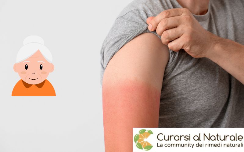 eritema solare rimedi della nonna eritema solare rimedi della nonna
