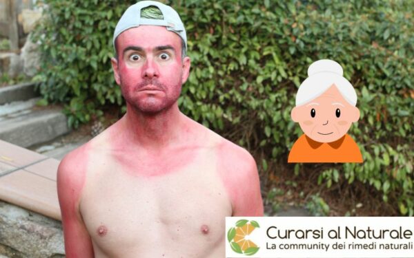 scottature solari rimedi della nonna