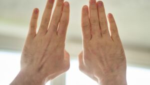 Macchie marroni sulle mani